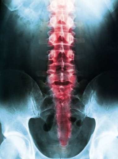 Chiropractic xray of spine