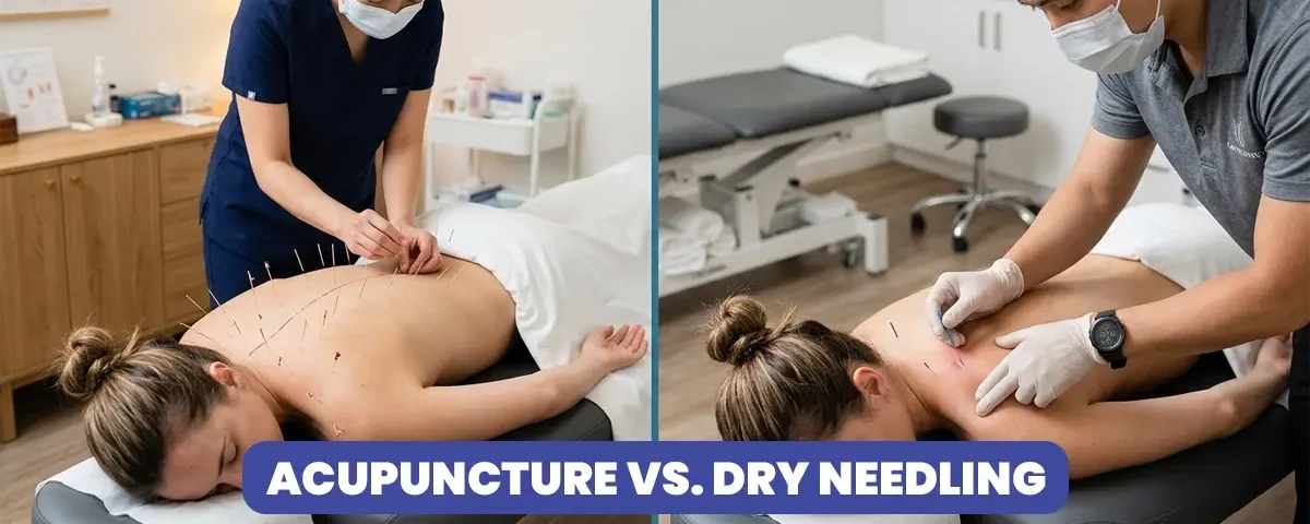 Acupuncture vs Dry Needling
